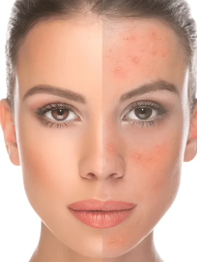 9 Best Home Remedies for Acne and Acne Scars